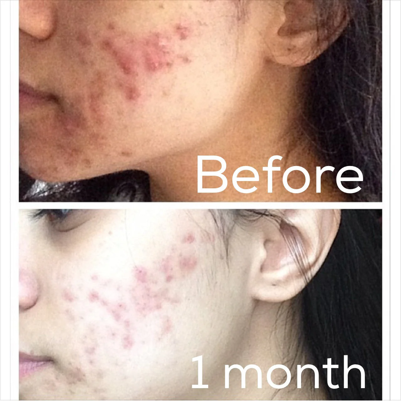3-Step Acne System - Image 10