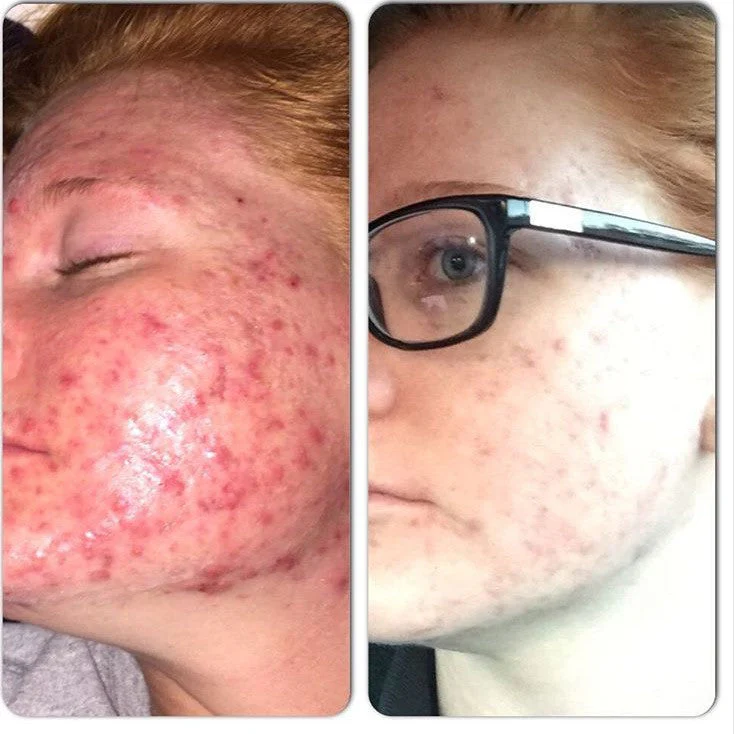 3-Step Acne System - Image 11
