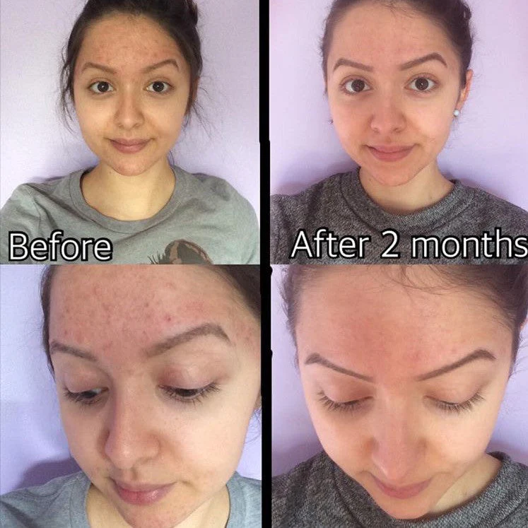3-Step Acne System - Image 6