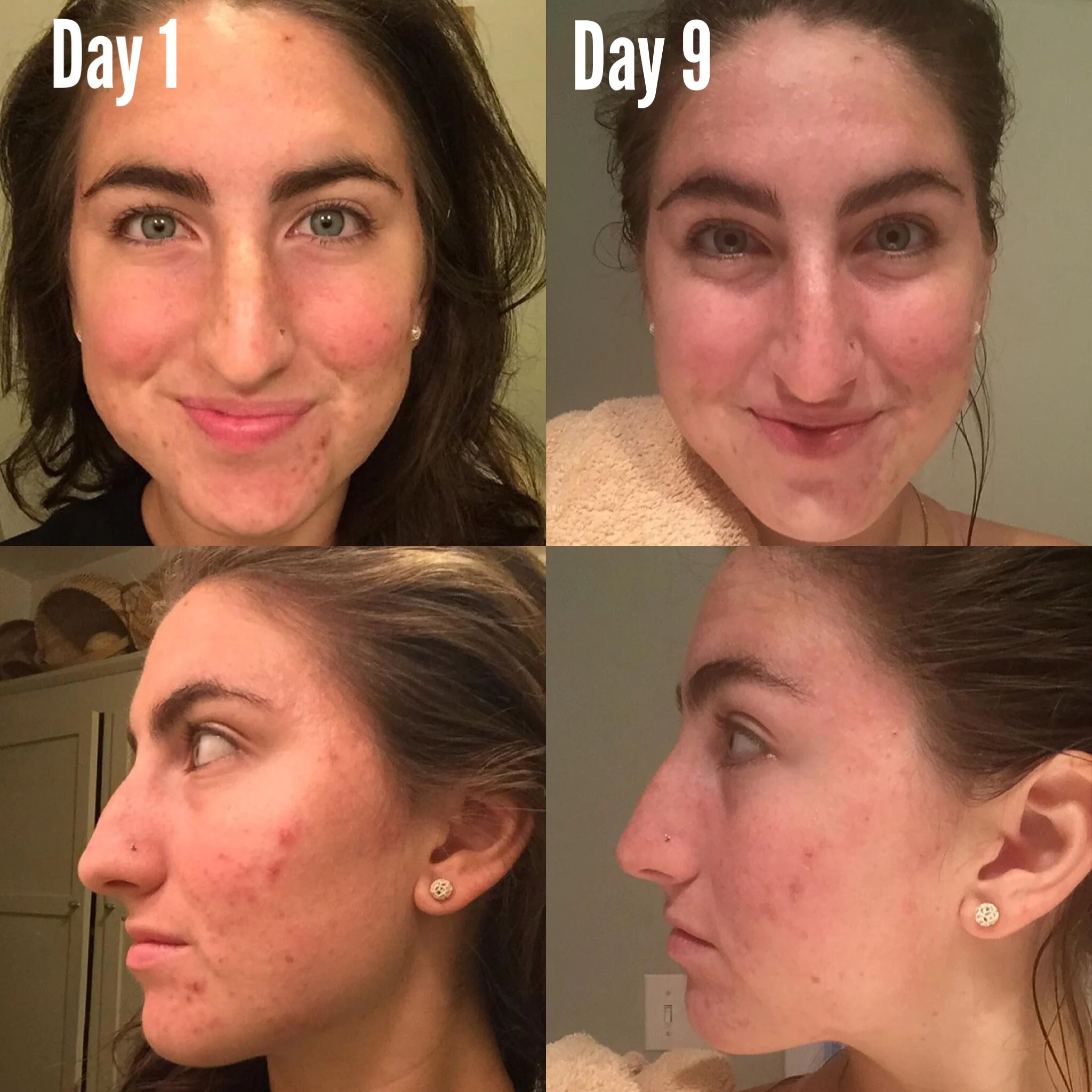 3-Step Acne System - Image 7