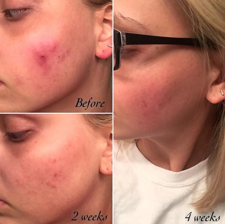 3-Step Acne System - Image 8