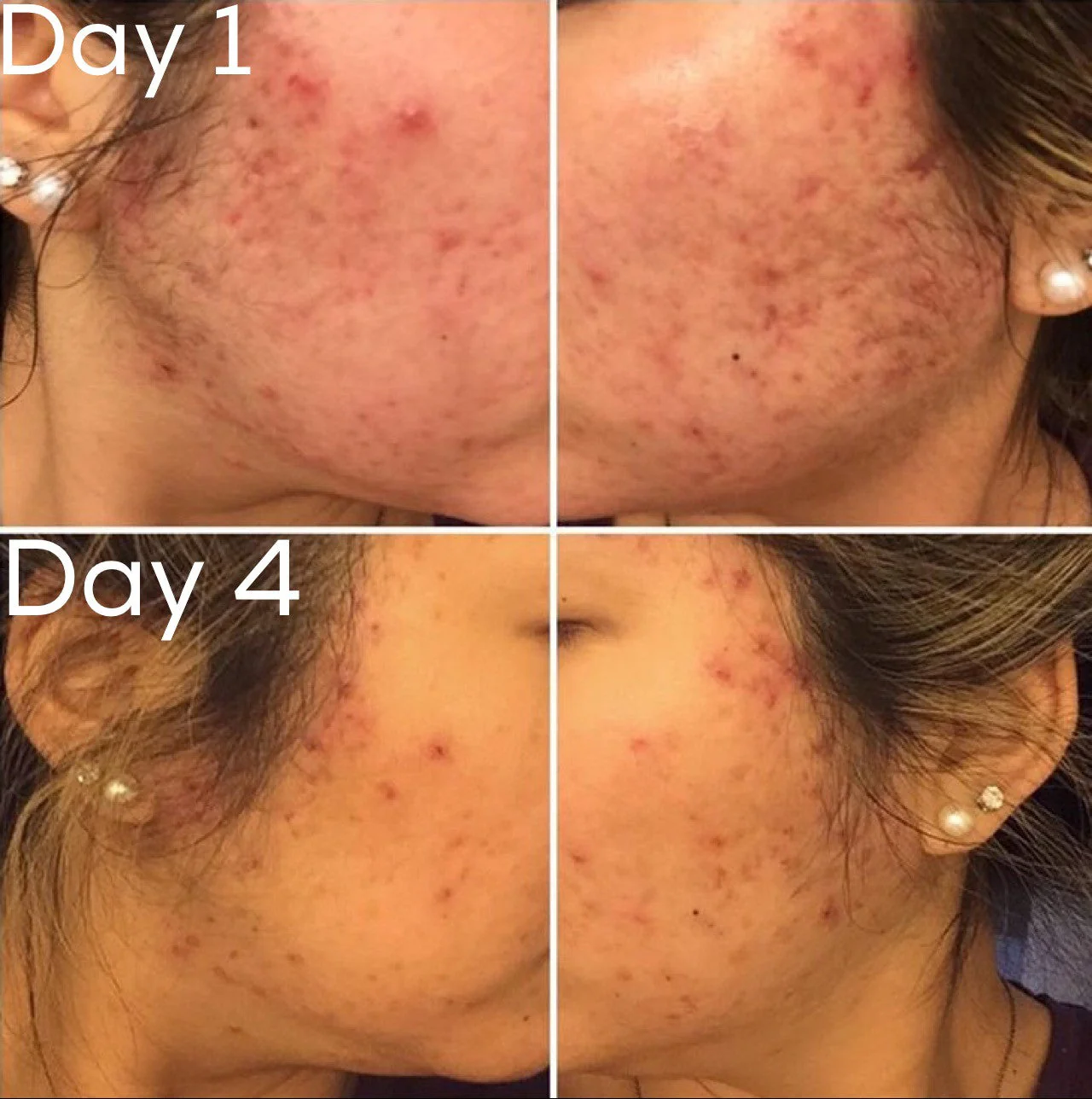 3-Step Acne System - Image 9