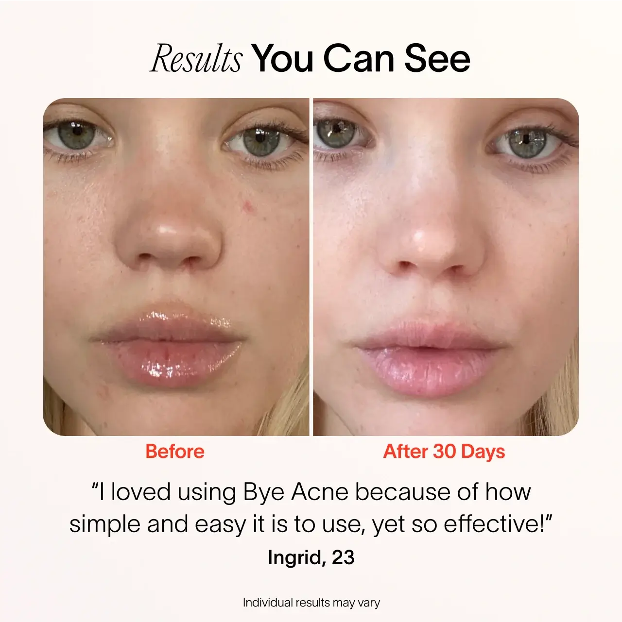 Bye Acne: 3-Minute Pimple Spot Treatment - Image 15