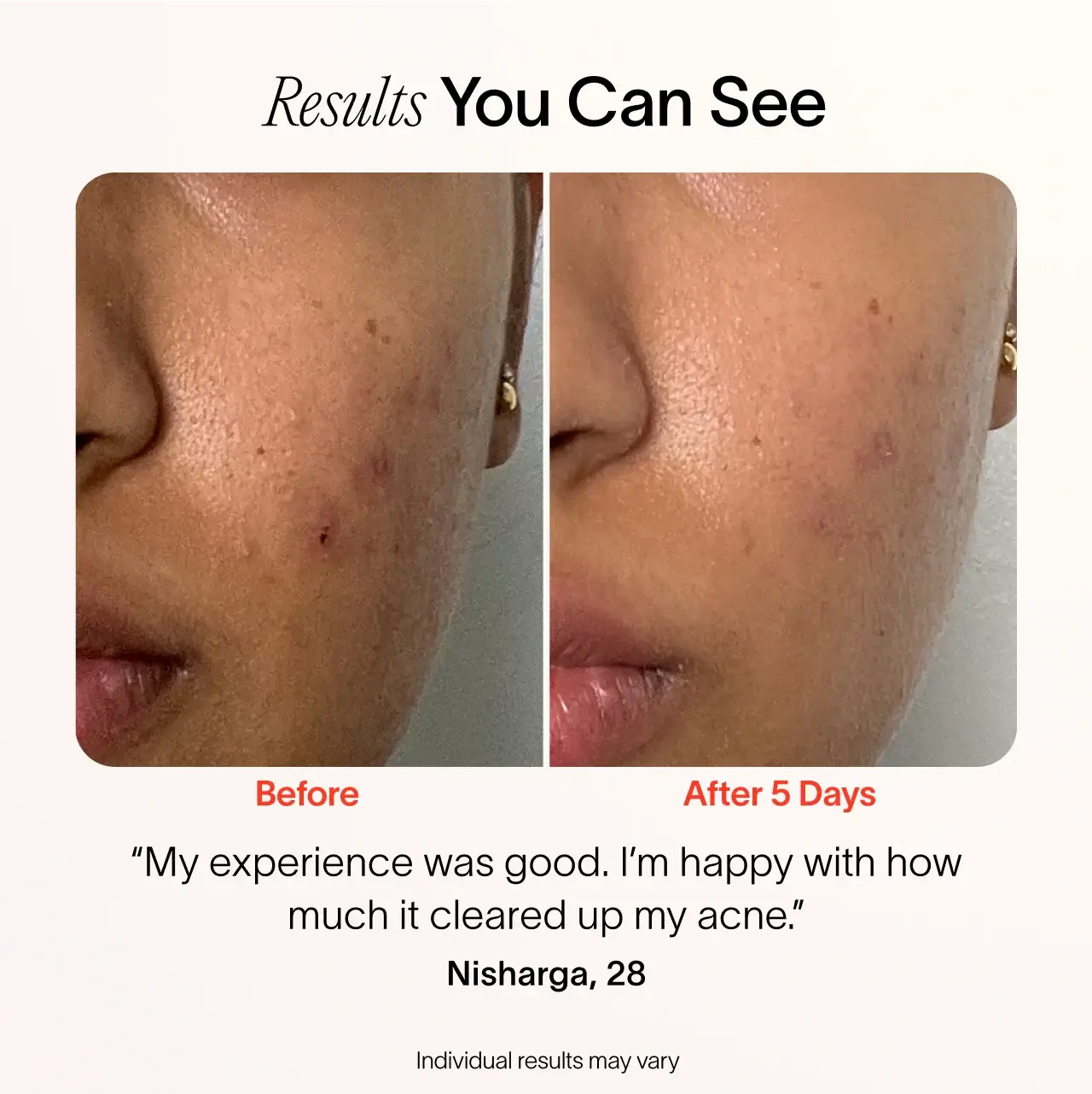 Bye Acne: 3-Minute Pimple Spot Treatment - Image 6